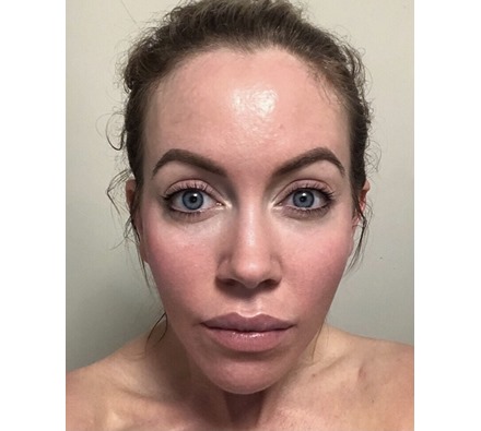 Skin transformation by Dr Leah Clinic