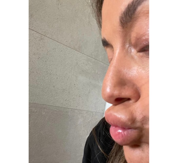 Before and after dissolving lip filler at Dr Leah Clinics