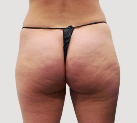 Before and after Lanluma non-surgical bum lift