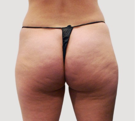 Lanluma Bum Lift Before and After (2 Vials 4 weeks apart)