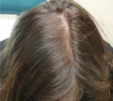 PRP Hair Loss Treatment Before and After 