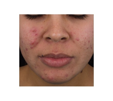 Before and after peel acne treatment