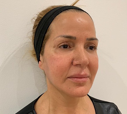 Liquid facelift before and after