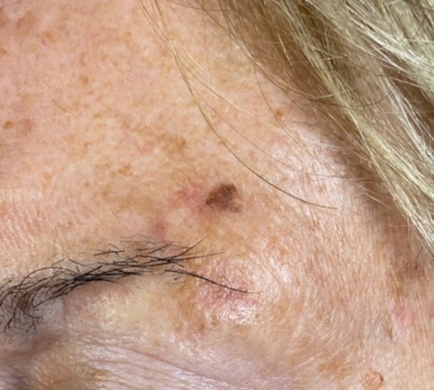 Skin imperfection before and after cryotherapy