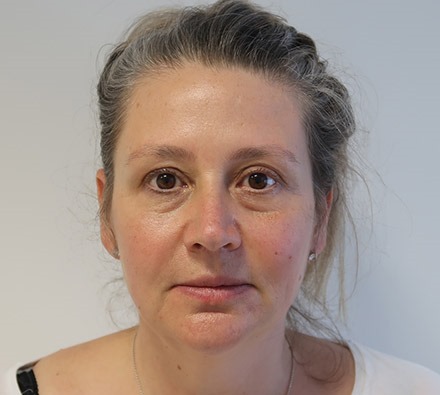 Under eye tear trough filler before and after