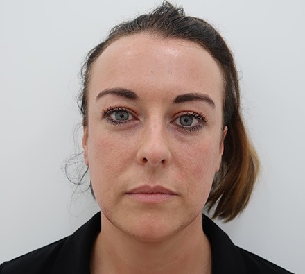 Lip filler before and after (1ml)