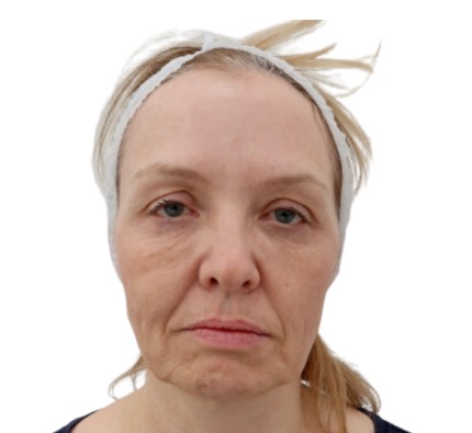 Before and after thread lift