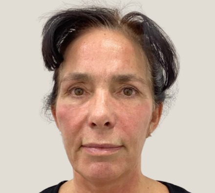 Before and after Morpheus8 treatment. Individual results may vary.