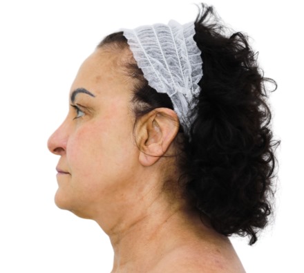 Before and after thread lift