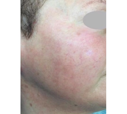Before and after course of 6 vascular laser treatments