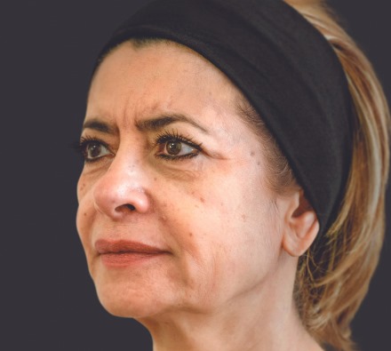 Here are some examples of the results we're able to achieve with Ellansé dermal filler...