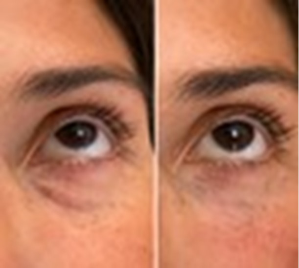 Polynucleotide eye treatment before and after