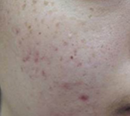 Before and after course of 6 Dermapen treatments
