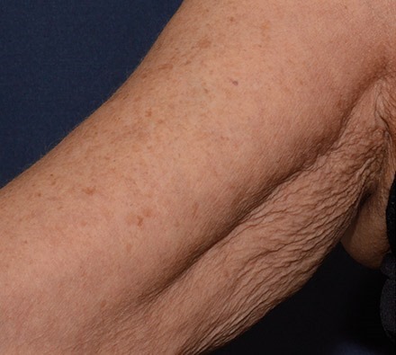 Profhilo underarm before and after