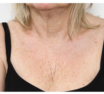 Lanluma V Decolletage Before & After 