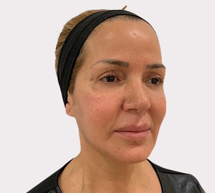 Liquid facelift