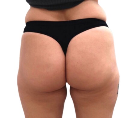 Lanluma Bum Lift Before and After 