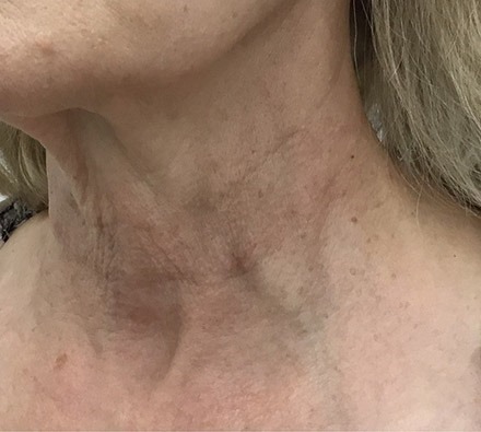 Ultherapy Neck Before and After, *Individual results may vary