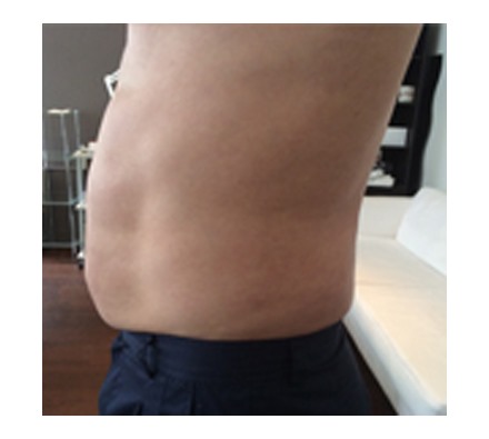 Fat dissolving injection