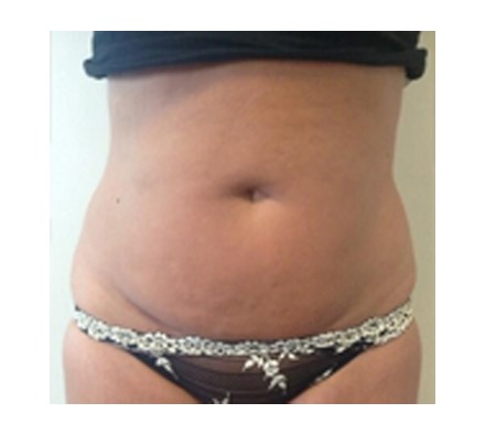 Fat freezing plus course of 6 inch loss
