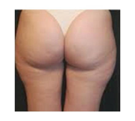 Cellulite treatment