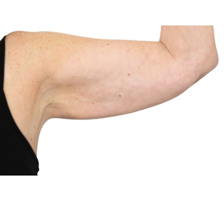 Lanluma V Arm Before & After 