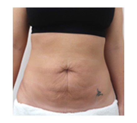 Mummy tummy makeover