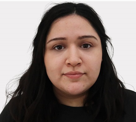 Under eye tear trough filler before and after