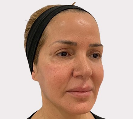 Liquid facelift before and after