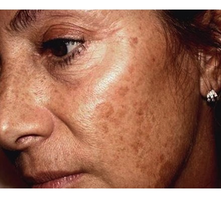 Before after after pigmentation laser treatment