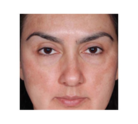 Obagi Nu derm results (12 Week Treatment)