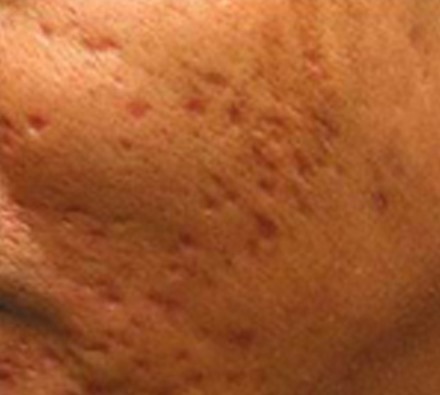 Before and after course of 6 Dermapen treatments