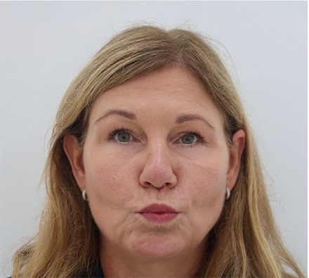 Plasma IQ: smokers' lines, upper and lower eyes.