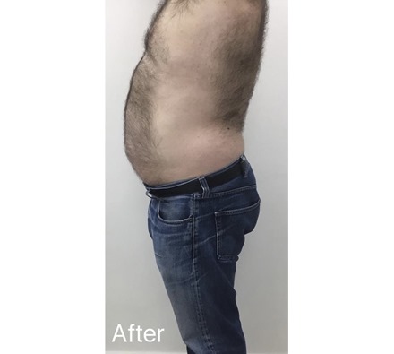 Fat freezing at Dr Leah Clinic (photos taken 8 weeks apart)