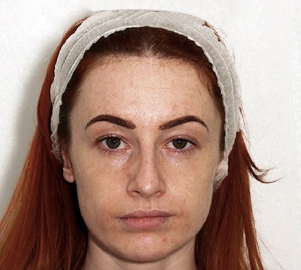 Fox eye lift before and after 