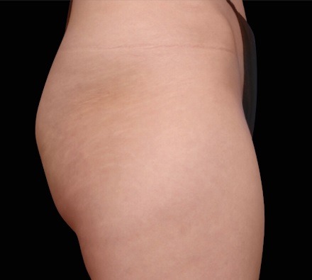 Buttocks before and after EmSculpt Neo. Photos courtesy of Lasky Aesthetics.
