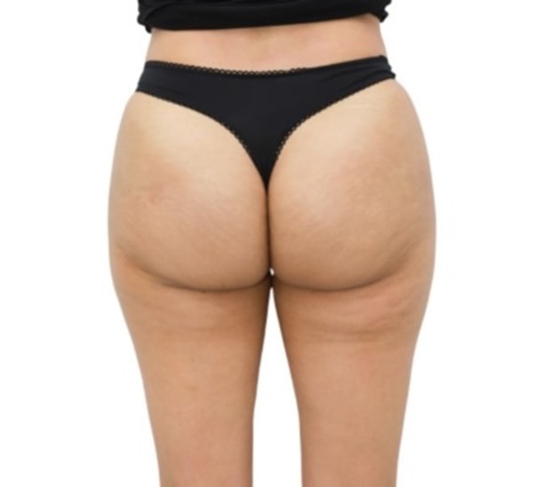 Cellulite on buttocks (before and after Lanluma treatment)