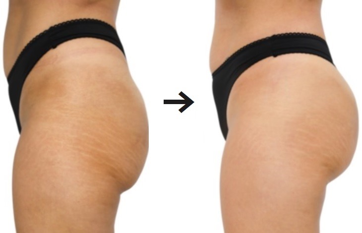 Non-surgical BBL
