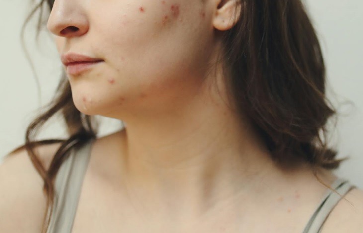 Acne
