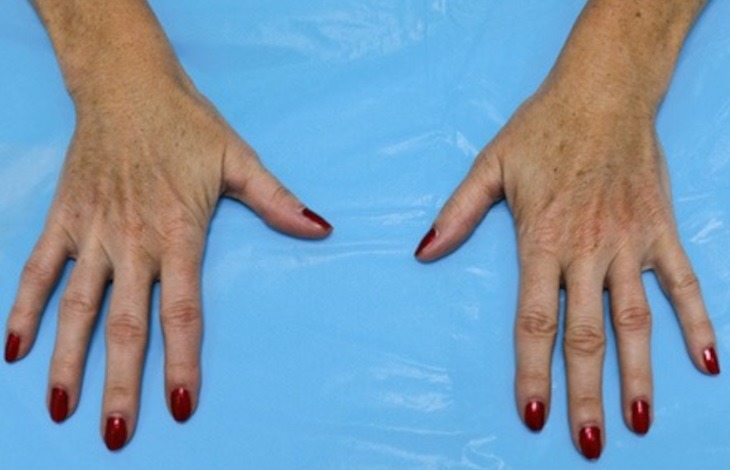 Liver spots on hands