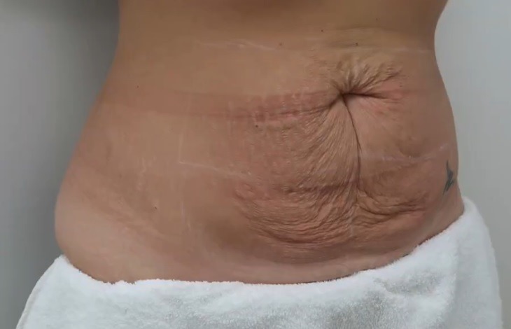 Post-pregnancy body