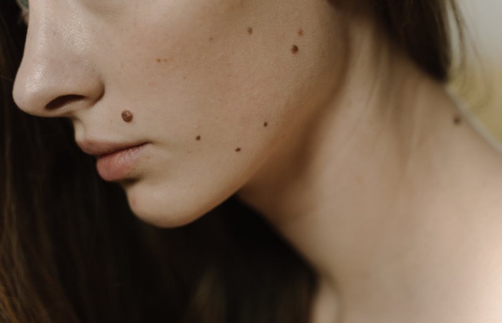 Facial moles