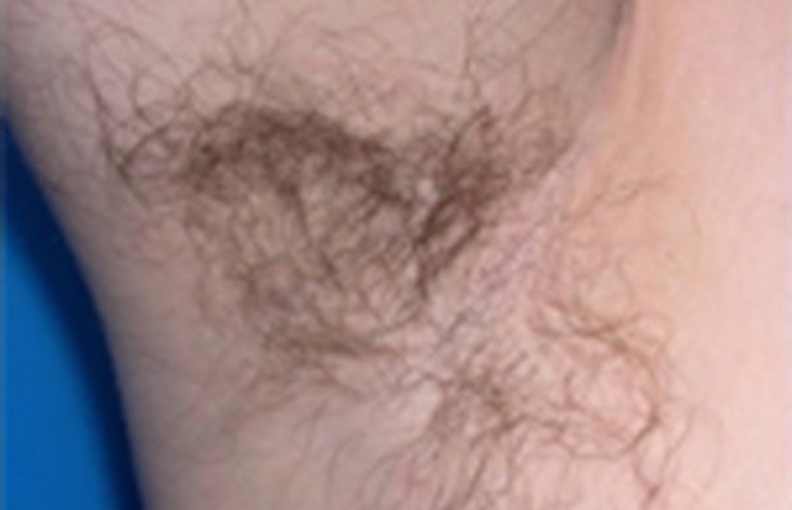 Unwanted hair