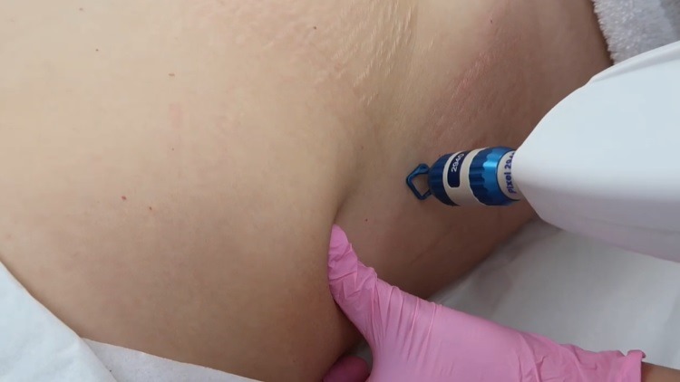 i-Pixel laser treatment