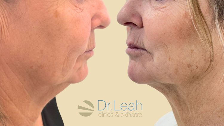 Quantum RF Neck Lift
