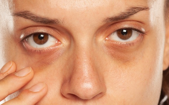 The Benefits of Polynucleotide Treatment for Under Eye Rejuvenation