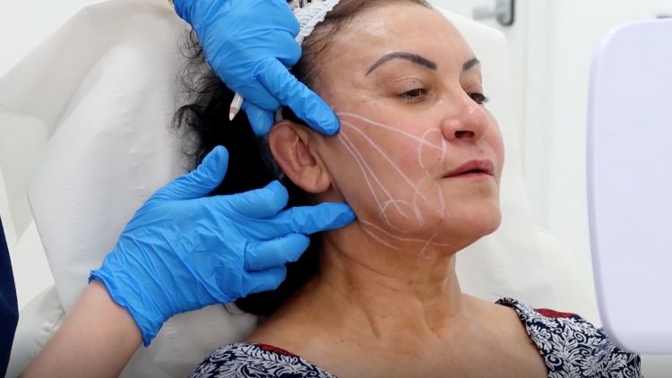 What is the Dr L Lift a.k.a 'The Happy Face Lift'?