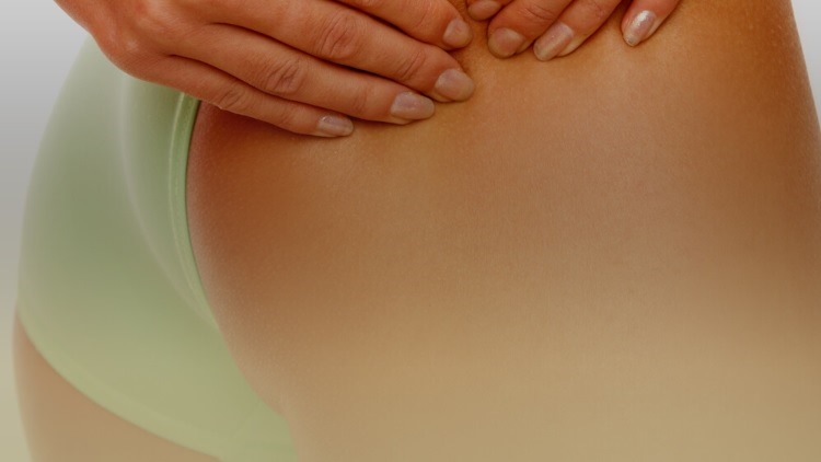 What is cellulite?