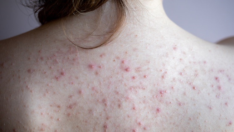 Back acne