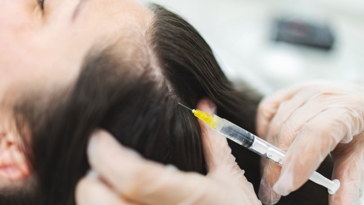 Exosome treatment for hair loss